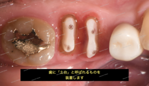 歯を抜かない・歯を残したい治療　矯正６